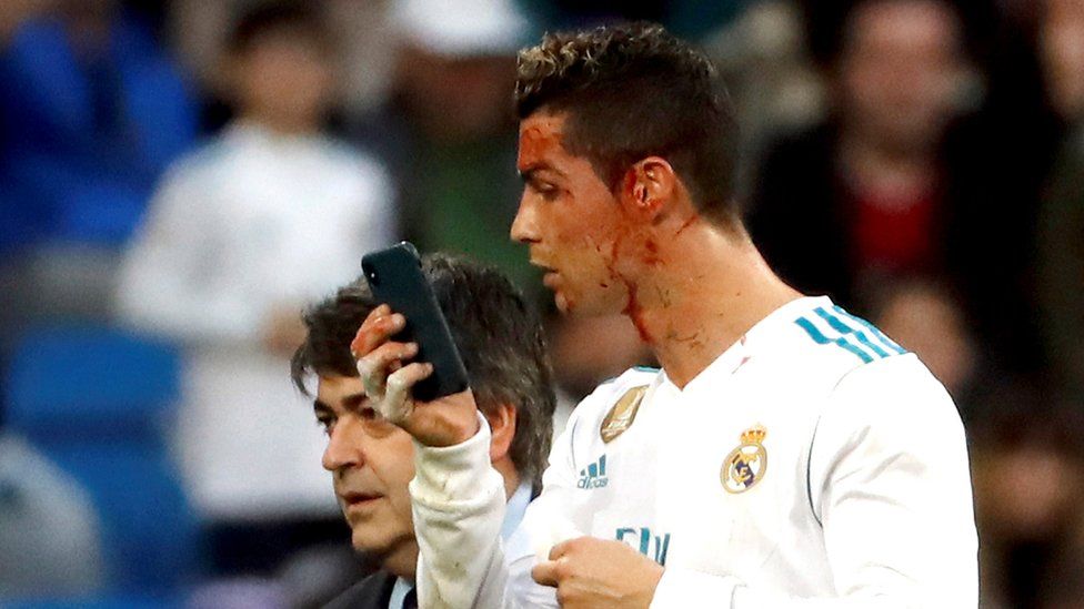 Cristiano Ronaldo checks his face in the front-facing camera of his attending physician's phone as he was led off the field