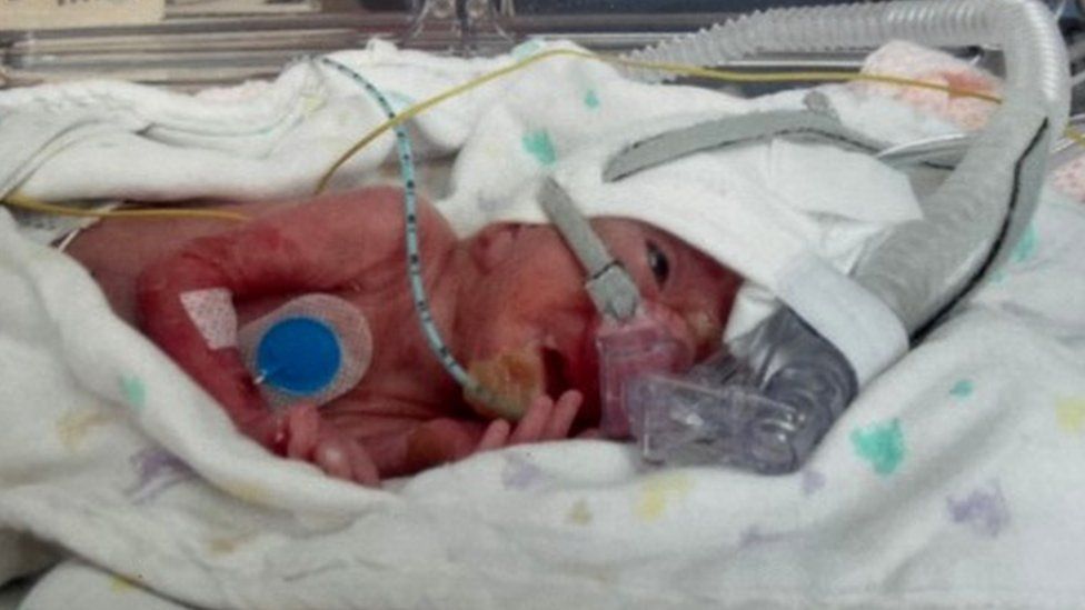 Ophelia weighed just 1lb 4oz when she was born