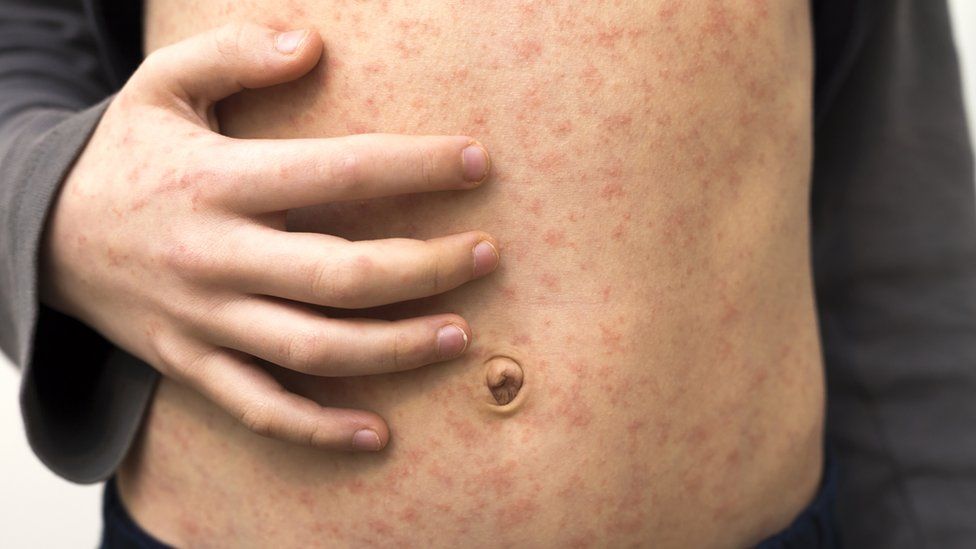 Stock photo of a child with a measles rash