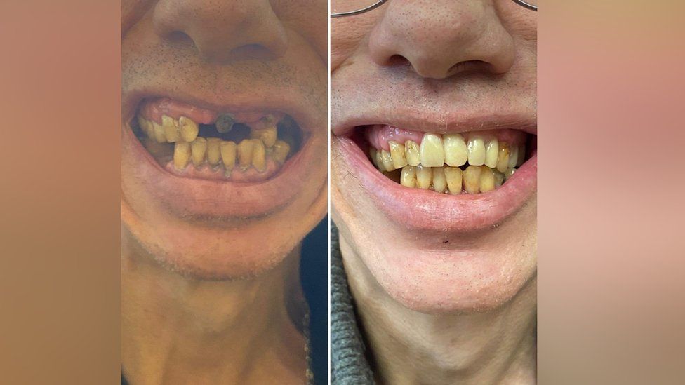 John Nicholsons Zähne vor und nach der Behandlung