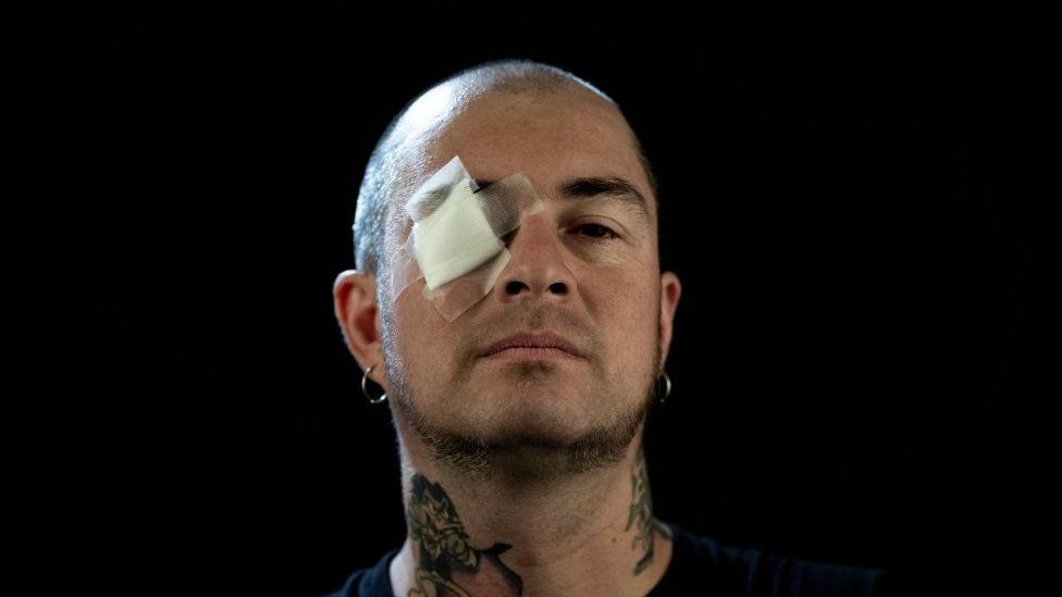 Чилийский музыкант Серджио Конча, 42 года, которого во время акции протеста настигла дробь полиции и который потерял зрение, позирует перед камерой в Сантьяго, 4 декабря 2019 года.