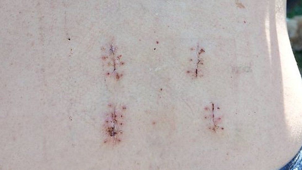 The scars on Mr Richardson's back after two steel rods supporting his vertebrae were inserted, leaving him in constant pain