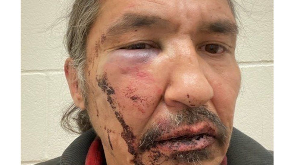 Athabasca Chipewyan First Nation Chief Allan Adam after a violent arrest