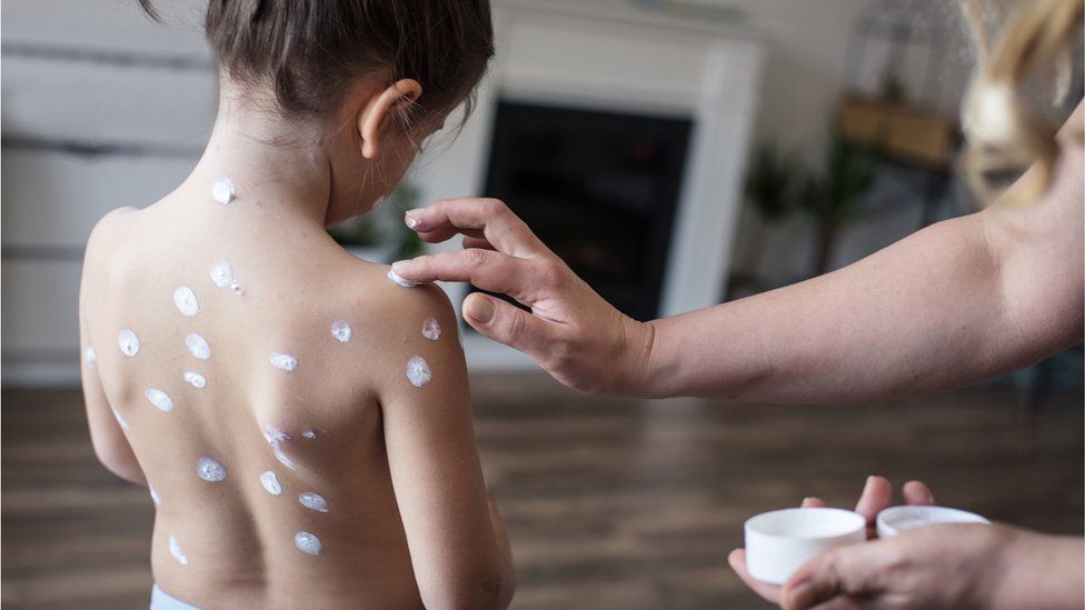 Child with cream applied on blisters