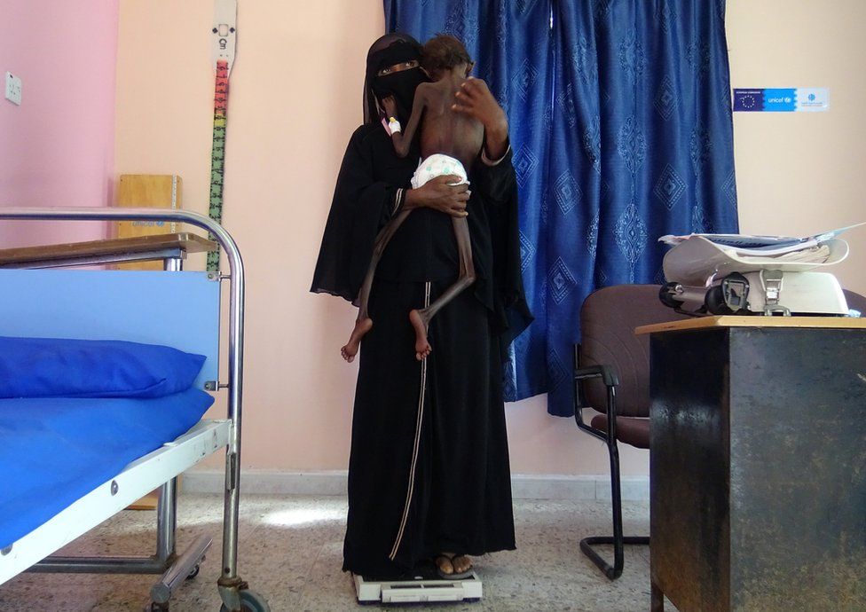 A woman holds her malnourished child in a clinic