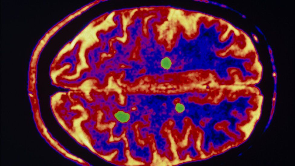 Brain in patient with MS