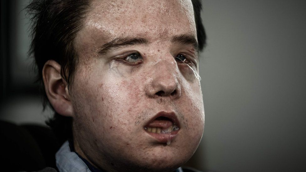 Jerome Hamon, the first man in the world to twice undergo a face transplant