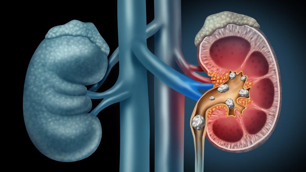 tratamiento natural para disolver cálculos renales