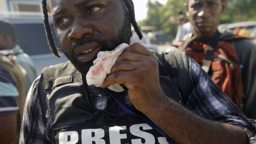 Photojournalist Chery Dieu Nalio holds a healing gauze next to his mouth