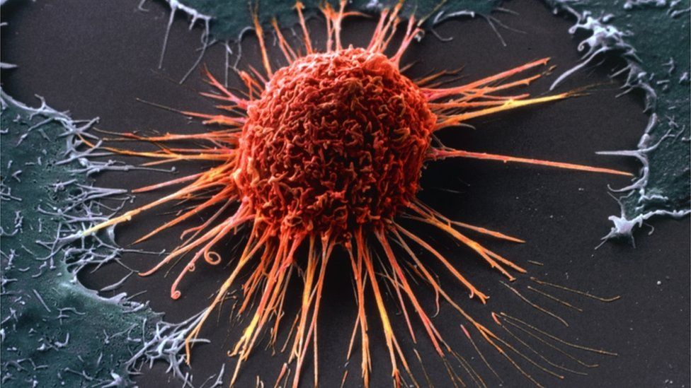 A coloured scanning electron micrograph (SEM) of a cervical cancer cell.