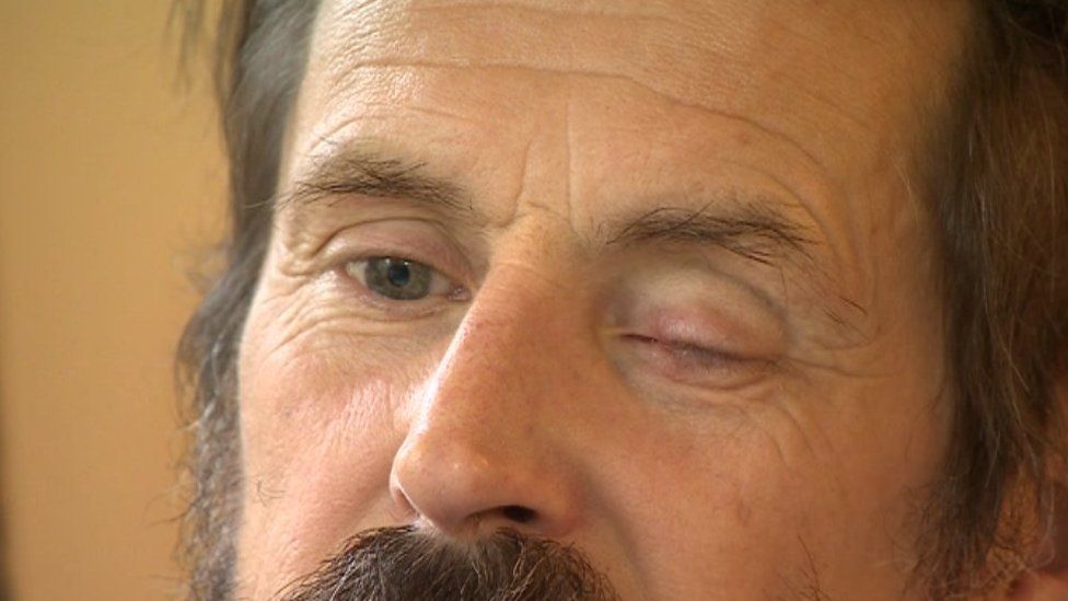 Aksel's injured eye a year later
