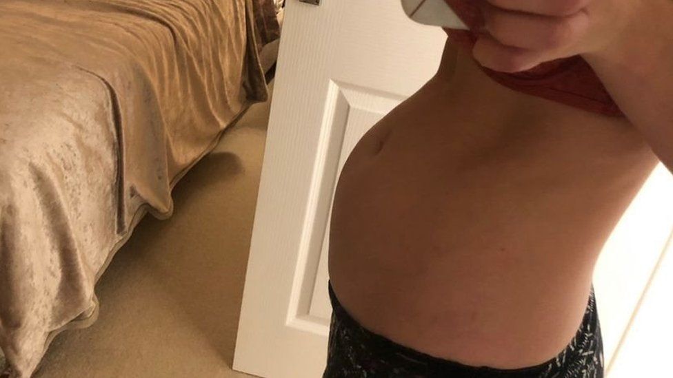 Natalie's "bump" from endometriosis