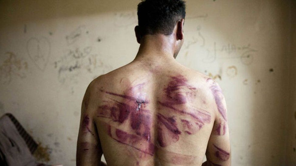 Syrian victim of torture