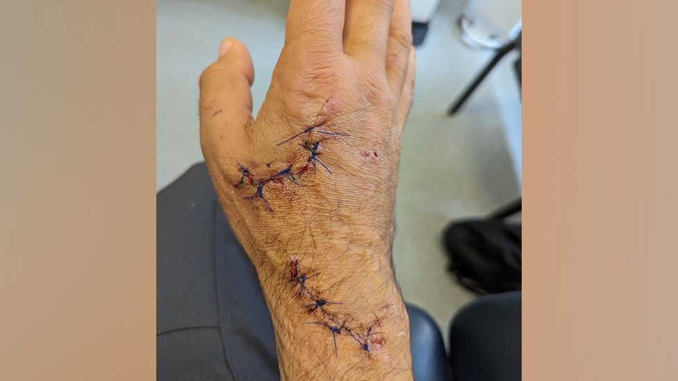 Gualberto Ramirez' hand with stitches after dog attack