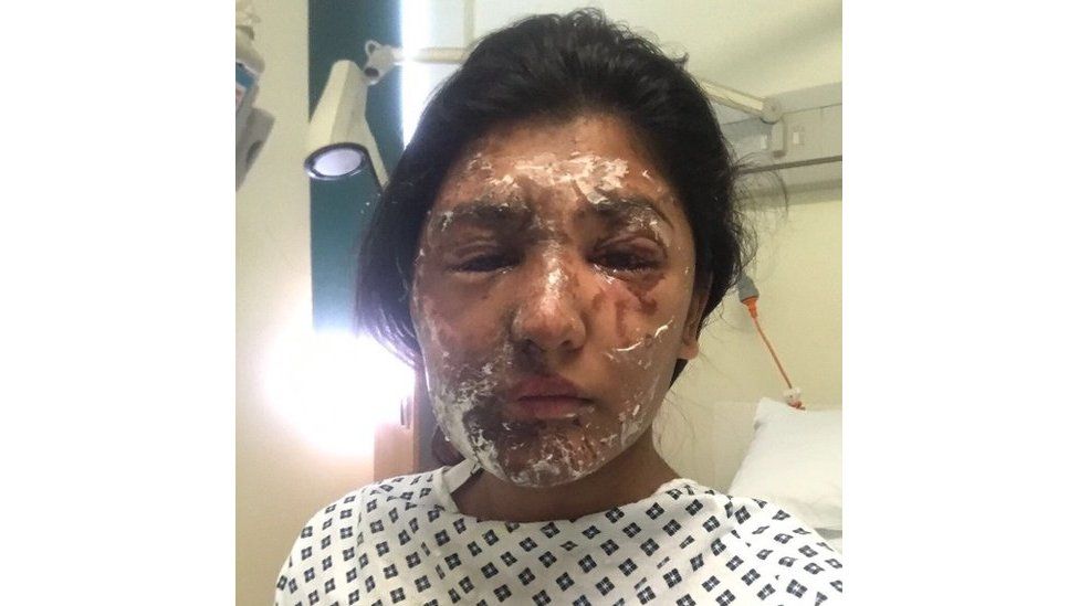 Resham Khan with facial burns