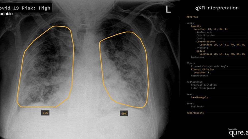 The Groundbreaking Way To Search Lungs For Signs Of Covid 19 c News