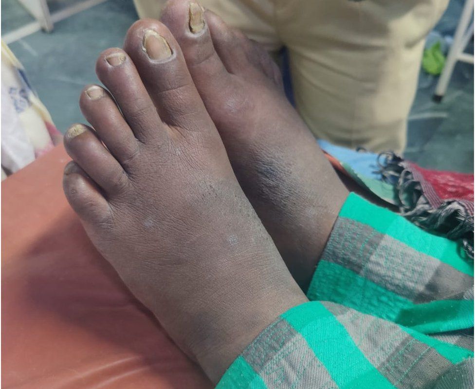 Подросток, ставший жертвой пыток из Гургаона в феврале 2023 года, в больнице