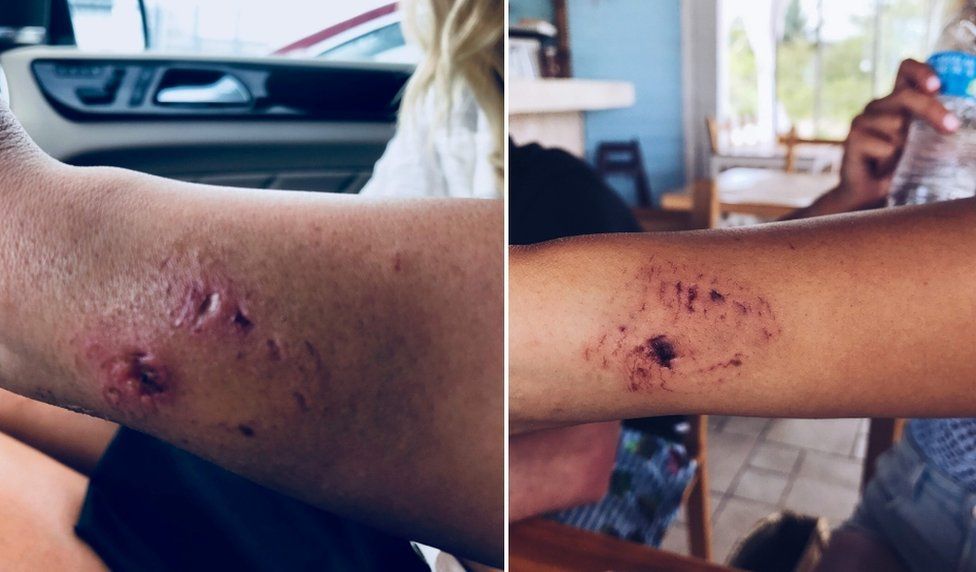 Deep teeth punctures are pictured on her arms in fresh and partly healed images
