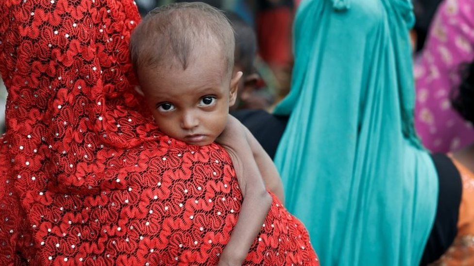 A malnourished Rohingya refugee in Cox's Bazar, Bangladesh. Photo: 24 September 2017