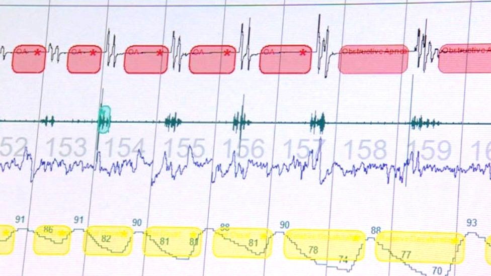 Computer screen with sleep test results on.