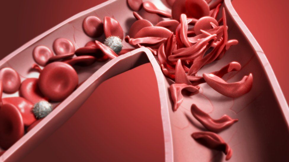 preguntas y respuestas de anemia falciforme preguntas y respuestas de anemia falciforme