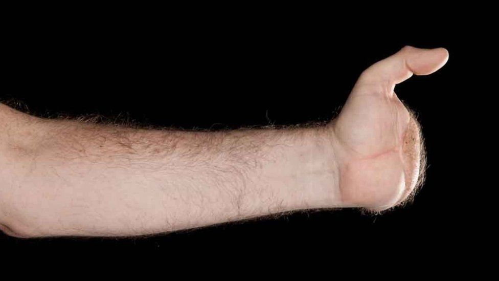 The left hand of the UK's first double hand transplant patient Chris King, from Doncaster, before his double hand transplant operation