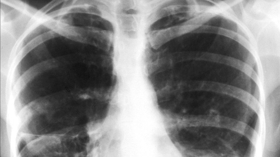 An X-ray showing signs of tuberculosis
