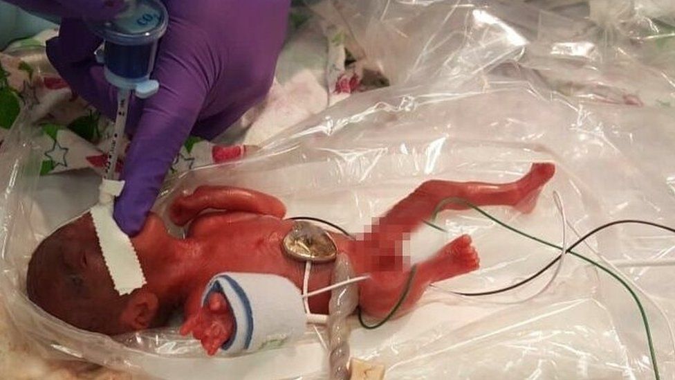 Premature baby in intensive care at Sharp Mary Birch Hospital