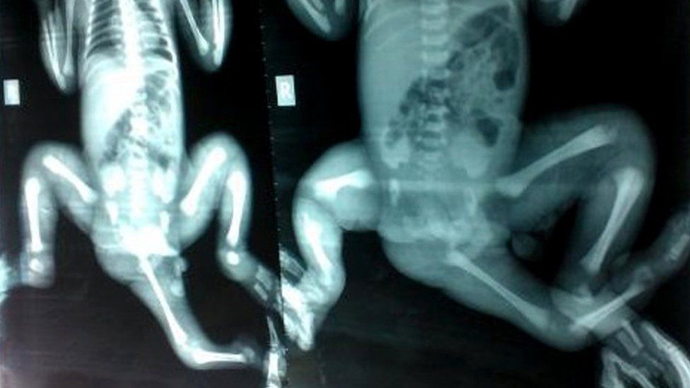 This undated handout photo received on 28 April 2017 shows an X-ray released by Monash Health of three-year-old Choity Khatun taken in hospital in Melbourne before she had life-saving reconstructive surgery