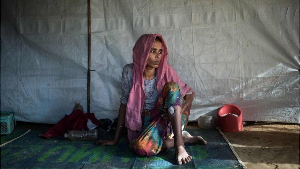 A Rohingya Muslim refugee Nosuba Khatun (40) shows the bullet wound inflicted while fleeing from an attack by the Myanmar military at her shelter in the Kutupalong refugee camp in Cox's Bazar on December 4 2017