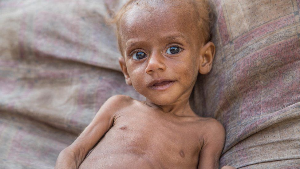 Nusair, 13 months old, lies on a bed in his house in Hudaydah, Yemen
