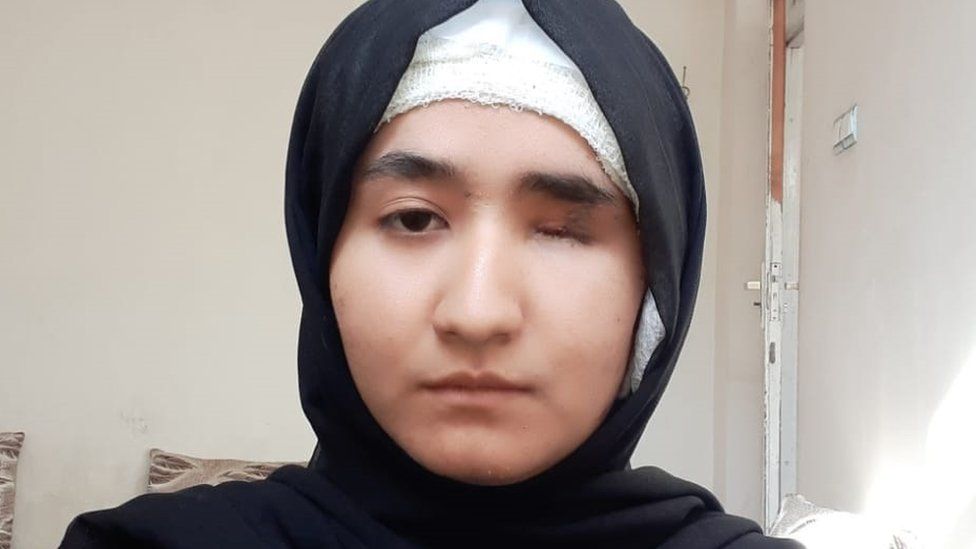Fatemeh Amiri lost an eye and had severe injuries after a bomber struck a tuition centre in Kabul