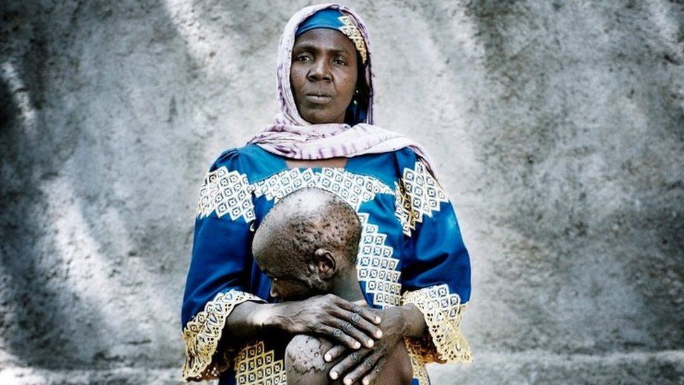 Falta Oumara, 40, with her badly burnt son Modou, 7 at an informal IDP camp for women and children in Mémé