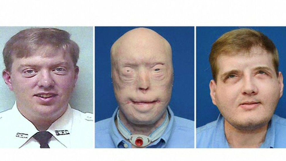 Patrick Hardison's face transformation in three stages