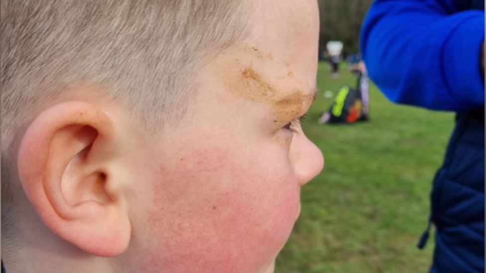 Youth rugby player with dog mess on his face