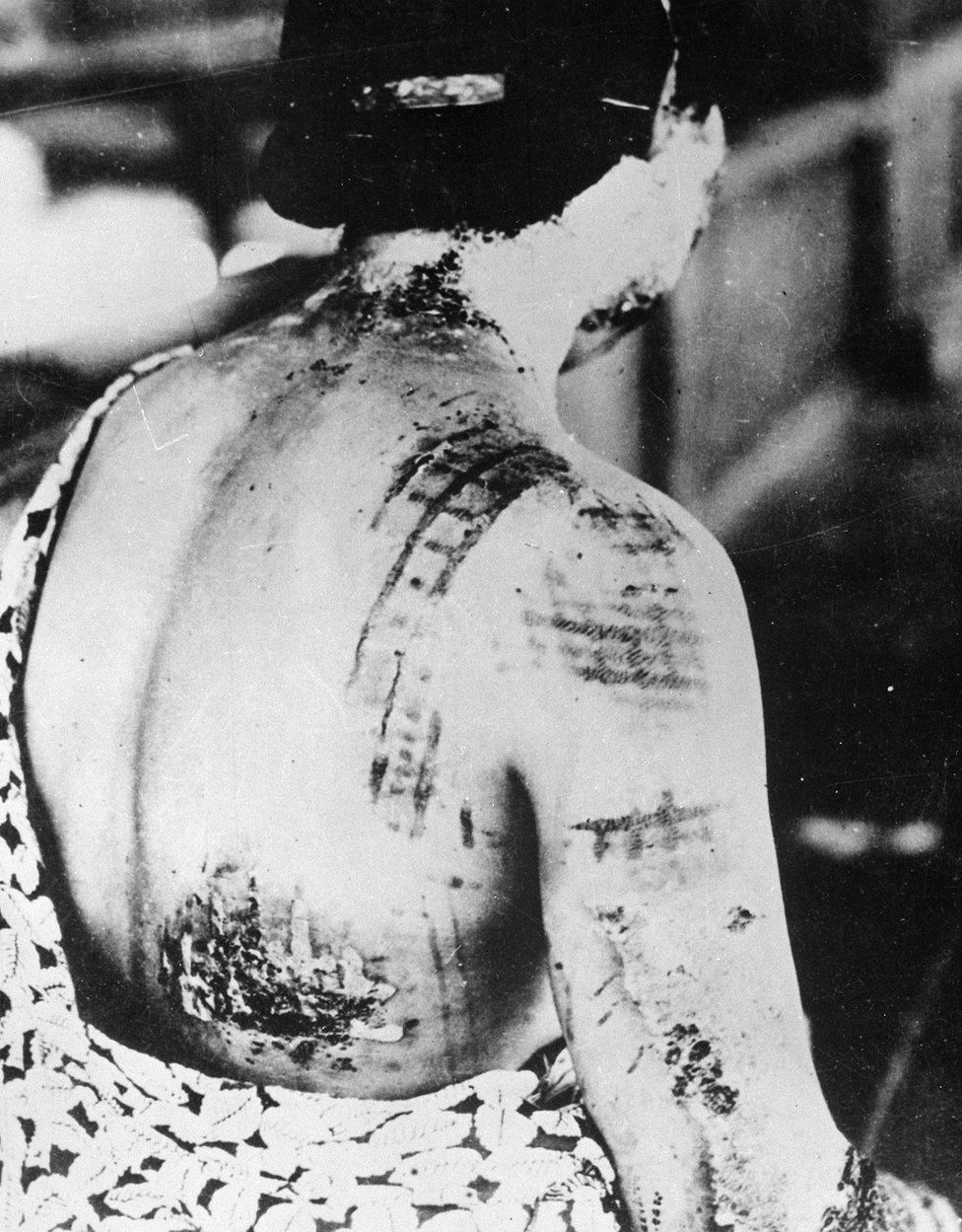 The patient's skin is burned in a pattern corresponding to the dark portions of a kimono worn at the time of the explosion