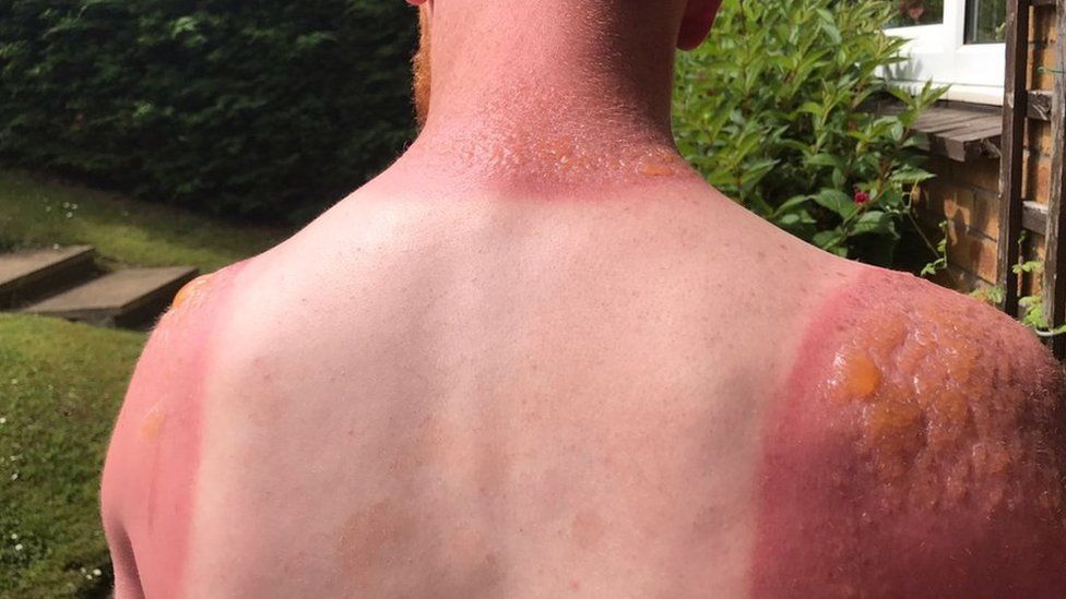 Heatwave leaves Edinburgh gardener with second-degree burns - BBC ...