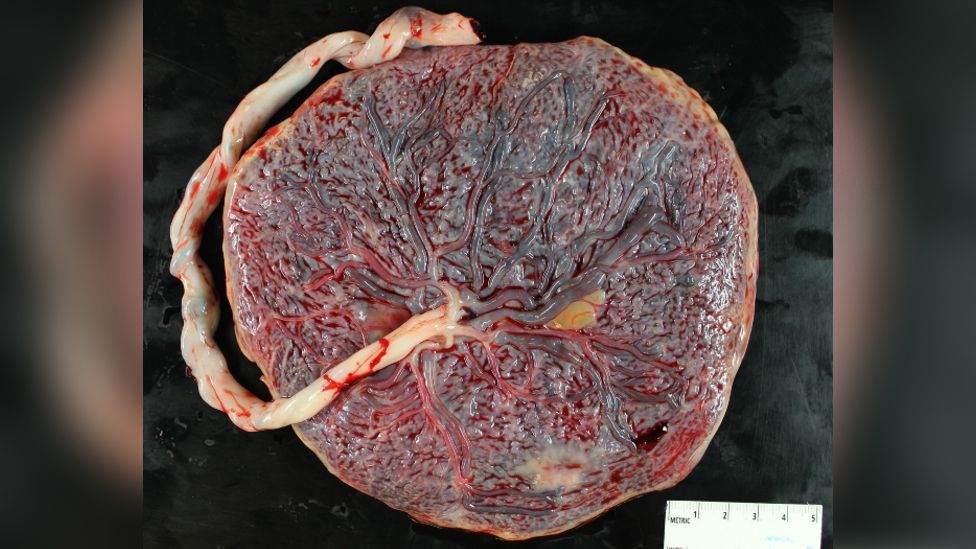 Placenta on a black background