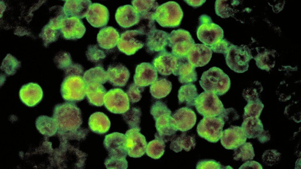 "Brain-eating" amoebas have been rediscovered in the New Orleans area