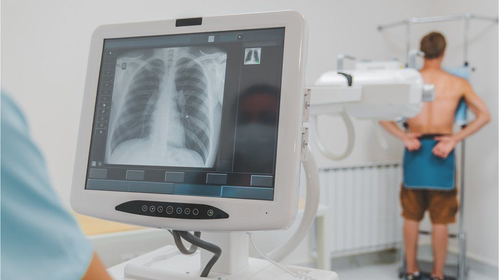 file picture of chest x-ray