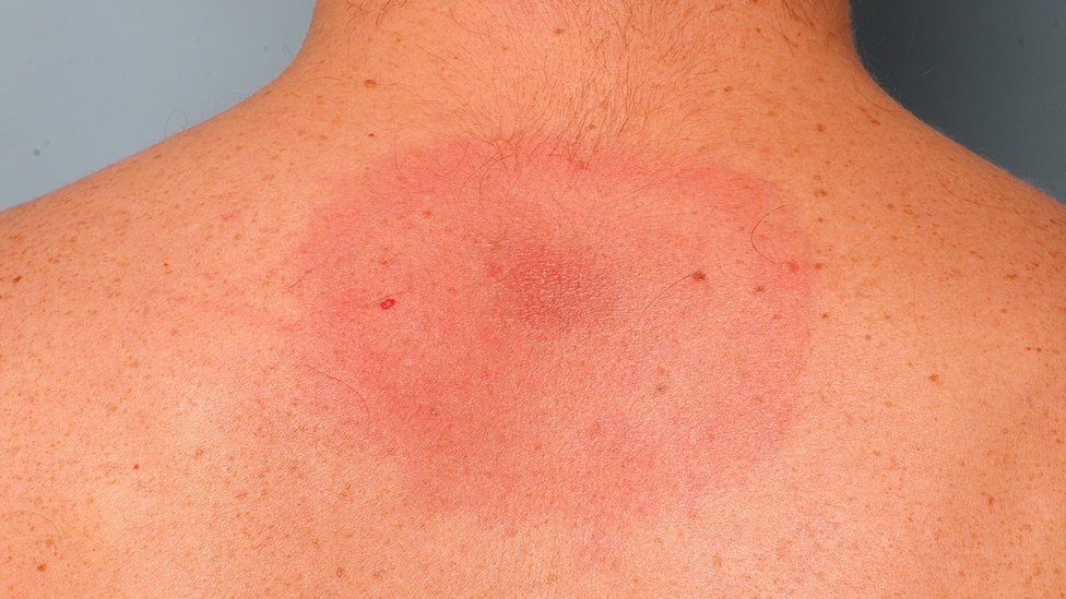 Lyme disease rash