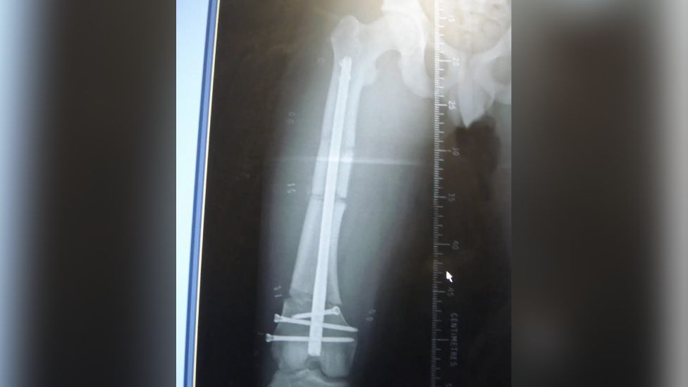 X-ray of femur surgery