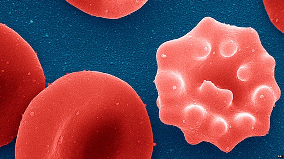 malaria-infected red blood cell