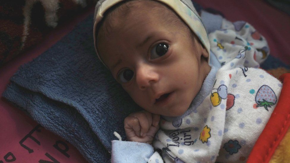 Six-month-old Taqua Tarish, who is suffering from severe malnutrition, in Marib Hospital