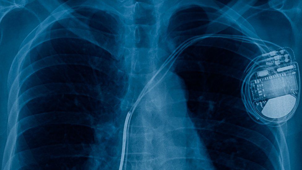 X-ray of a pacemaker
