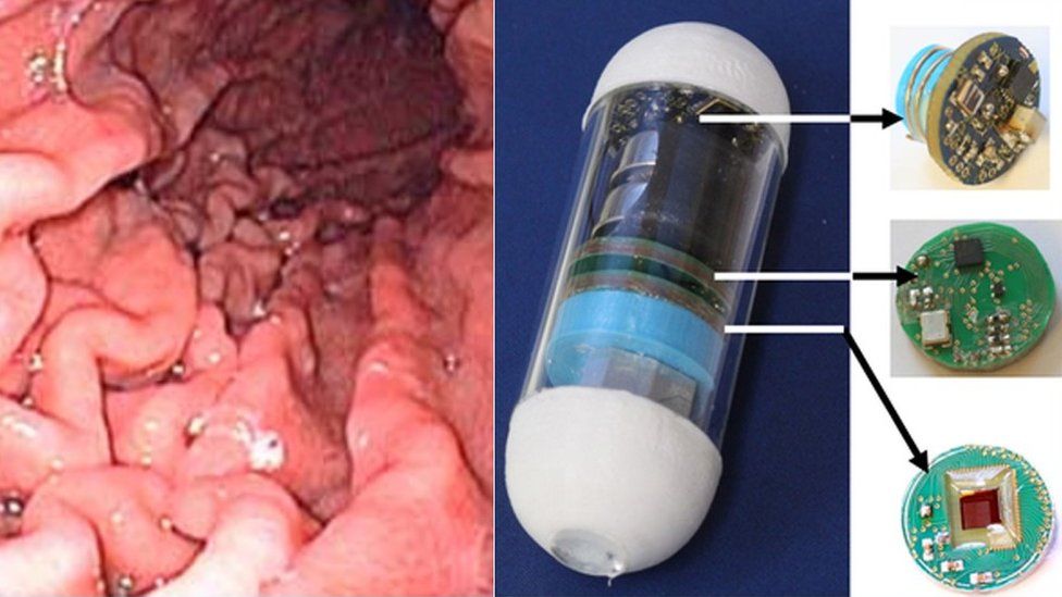 Endoscope image of stomach and a video pill