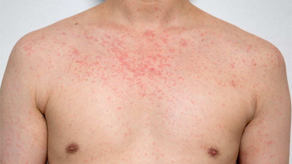 man with measles