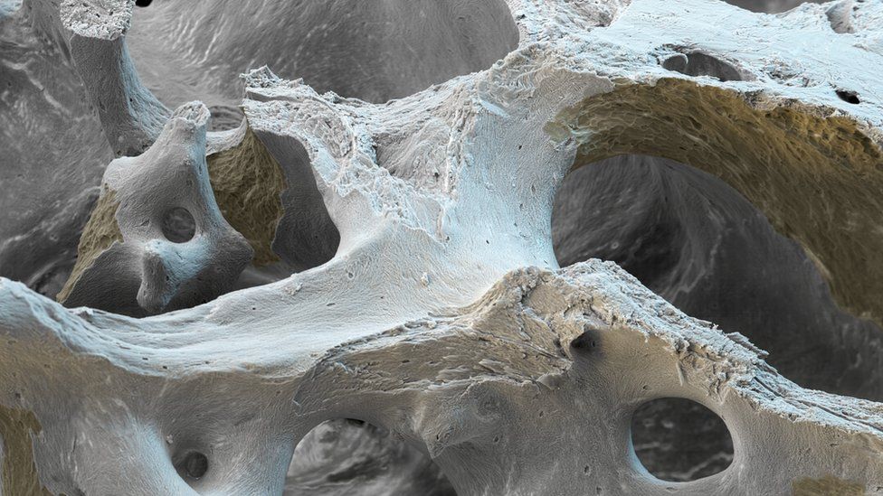 Osteoporotic bone, coloured scanning electron micrograph