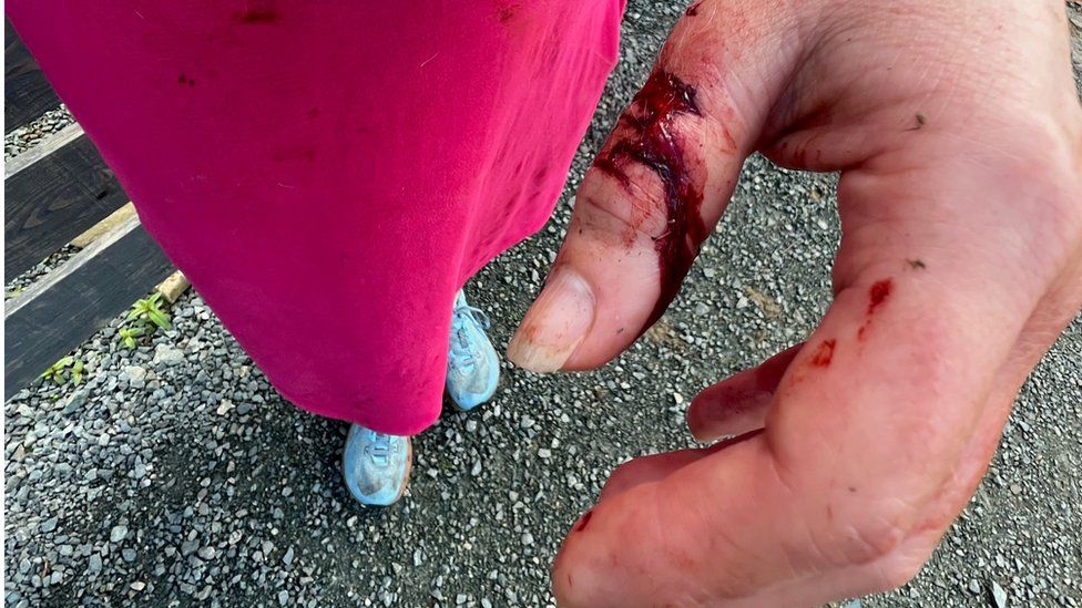 Tamsin Speight's thumb was injured in the attack