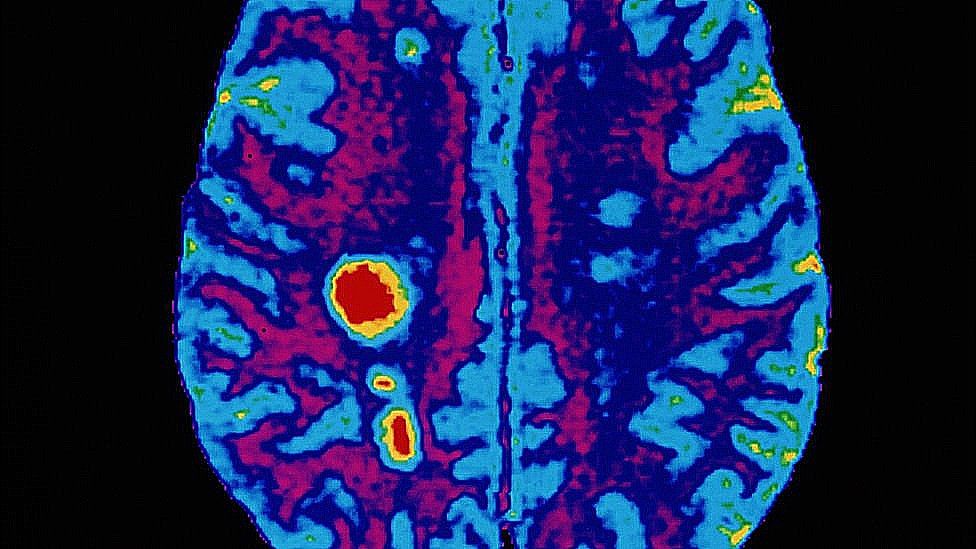 A brain scan showing signs suggestive of multiple sclerosis